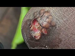 Yohana Ebole's heavy hands with jiggers #1 - full videos on riseupsociety.net & ruskenya.org