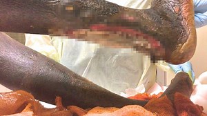 Grim video shows homeless man's leg crawling with maggots - but doctors say it SAVED him from deadly infections