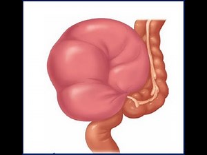 Sigmoid Volvulus