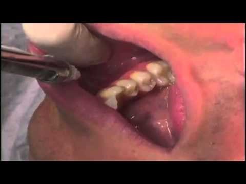 The Dental Box--Mental Nerve Block