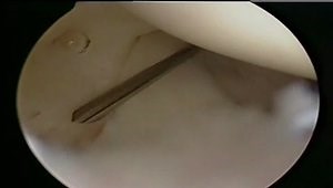 Diagnostic Shoulder Arthroscopy and Bursoscopy