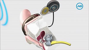 How A Cochlear Implant Works by Advanced Bionics on Make a GIF
