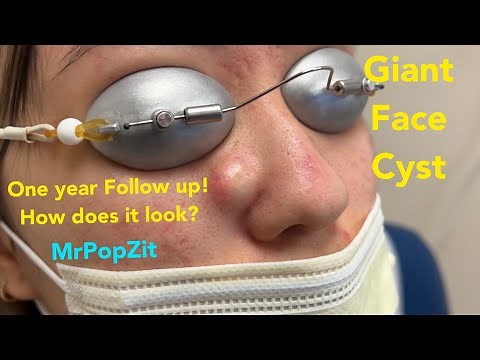 Exclusive only here Face cyst and Hidradenitis armpit follow up and multiple questions answered!