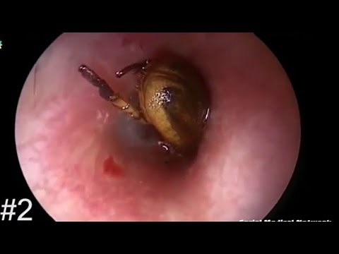 Top 5 Biggest Botfly Removal 2016