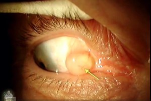 Conjunctival Cyst | Dr. Benjamin Karimov