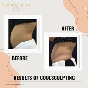 Coolsculpting is a non-invasive procedure, the risks, relatively...