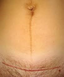 Caesarean Birth - St George's University Hospitals NHS Foundation Trust