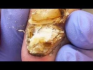 Toenail Fungus (Onychomycosis) Treatment【Podiatry Clinic】