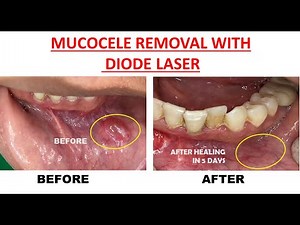 Mucocele removal with diode laser - Live Surgery - DR Rohan Virani