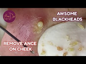 Remove AWESOME BLACKHEADS , Extract ACNE ON CHEEK | Suri Nguyen | Hien Nguyen Mina spa