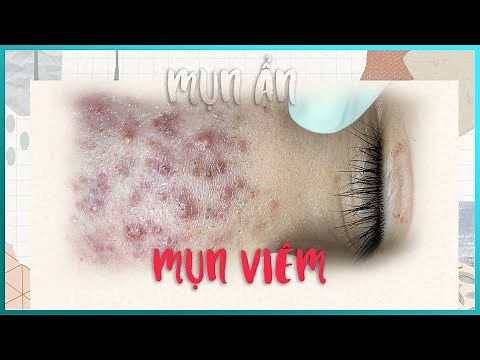 Big Cystic Acne Blackheads Extraction Blackheads & Milia, Whiteheads Removal Pimple Popping