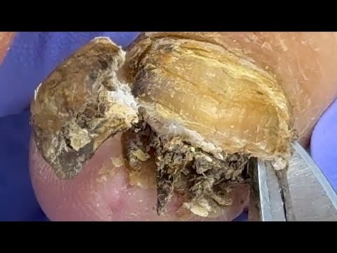 Super dirty onychomycosis, the germs have completely turned into black mud【Doctor Liu Pedicure】