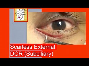 Scarless External DCR