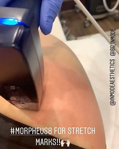 Morpheus8 is the perfect treatment to decrease the appearance of stretch marks!! . It remodels the tissue and builds new collagen to create a more even appearance of the skin!! . #morpheus8 #radiofrequency #inmode #owenhealthgroup #collagen #stretchmarks @inmodeaesthetics | Jenn the GYN
