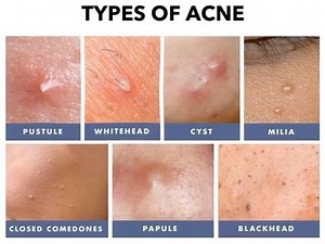1.7K views | It’s ALIVE !  different Acne types includes...