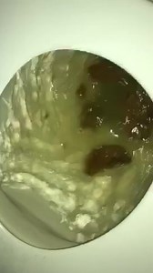 After breakfast urgent poopie