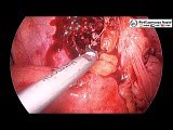 Laparoscopic Management of Perforated Appendicitis • Video • MEDtube.net