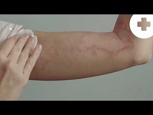 What is SCROTAL ECZEMA and How Does it Affect You?