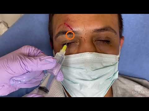 Supraorbital Nerve Block