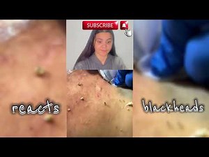 How to Get Rid of Blackheads on Back and Shoulders FAST – Satisfying Blackhead Removal