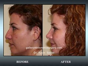 Rhinoplasty / Nose job before and after photos by Dr. Sadati