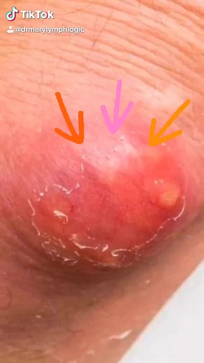 Carbuncle?#carbuncle #VibeWithUs #ouch #pain #infection#help #medical