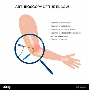 Illustration of elbow arthroscopy surgery. This is a procedure for diagnosing and treating joint problems. A surgeon inserts a narrow tube attached to a fibre-optic video camera through a small incision Stock Photo - Alamy