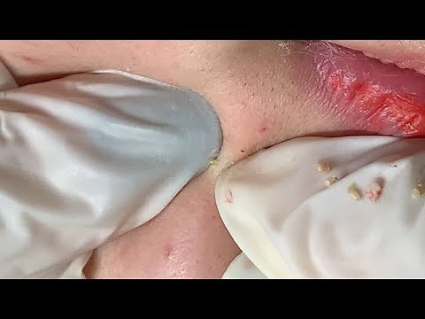 AWESOME BLACKHEADS AROUND THE MOUTH | Suri Job 140