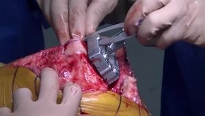 Total Knee Arthroplasty: Correction of Varus Deformity with the ATTUNE® Knee System