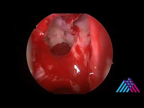 Functional Endoscopic Sinus Surgery (FESS) for Sinusitis
