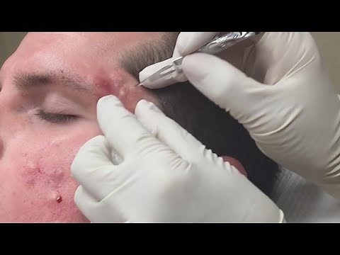 Super Satisfying Blackhead Removal