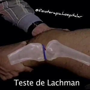 Teste de Lachman: ✔️Descrição O teste de Lachman é um teste de movimento passivo acessório do joelho, que é executado para identificar a integridade do ligamento cruzado anterior, ou LCA. O teste foi desenvolvido para avaliar a instabilidade do joelho no plano sagital. ✔️Técnica Com o paciente deitado de barriga para cima, coloque o joelho do paciente a cerca de 20-30º de flexão e a perna deve ser rodada externamente. O examinador deve colocar uma mão atrás da tíbia e outra na coxa do paciente. 
