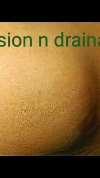 large gluteal abscess | incision n drainage #dr #youtube #doctor