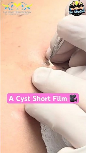 Simple Cyst Incision & Drainage by Dr. H.L. Greenberg Sort Form Video