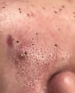 Pimple Popping Videos on Instagram: "Blackhead overload!!! #blackhead #blackheads #pimples"