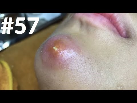 "🔴 Satisfying Pimple Popping Extravaganza! Watch the Most Satisfying Pops Ever!" #57