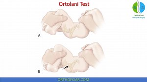 Ortolani Test