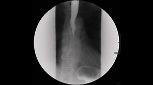 A radiografia com deglutição de bário: vídeo stock (100% livre de direitos) 3970065773 | Shutterstock