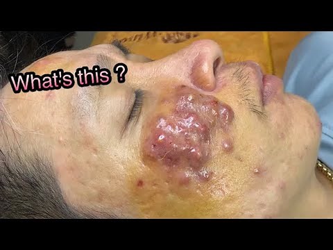 BOIL is severely inflamed | MỤN VIÊM NẶNG