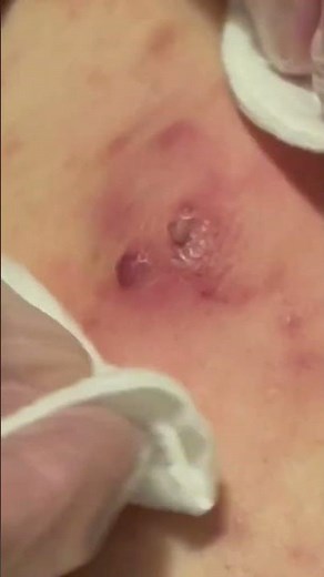 Cyst explosion! #pimple #extraction #popping #skincare #cyst #whiteheads #blackheads