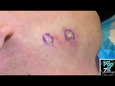 Jawline twinsie cysts. Excision and removal with cyst pop. Cysts under pressure. MrPopZit