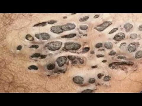 Nevus, Blackheads, Comedones and Dilated Pores of Winer