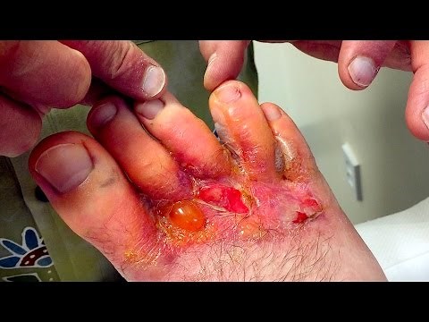 HORRIBLE FOOT RASH! (Infection?) | Dr. Paul