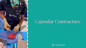 Capsular Contracture