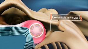 40K views · 217 reactions | A cervical herniated disc occurs when the...