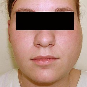 Parotitis - Symptoms, Causes, Treatment, and Pictures