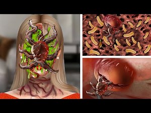 ASMR Remove Parasites, Big Pustules, Maggots on the face | Acne Deep Cleaning Animation