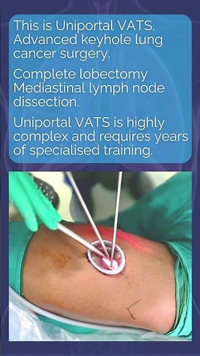 Keyhole Lung Cancer Surgery in India | Uniportal 3D VATS by Dr Abhishek Jain