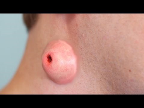 HUGE CYST ON NECK!