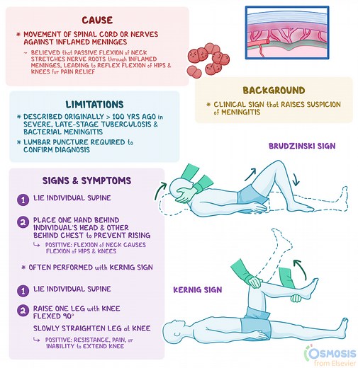 Brudzinski Sign: What Is It, How It?s Used, and More | Osmosis